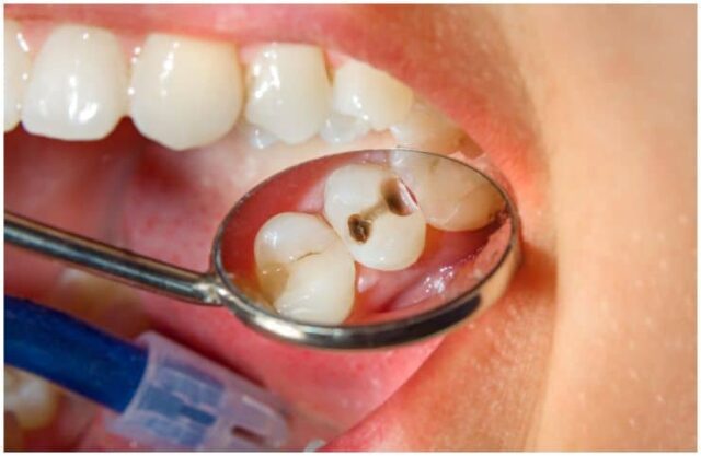 What Is The Spiritual Meaning Behind Teeth Problems Wisdom Teeth 