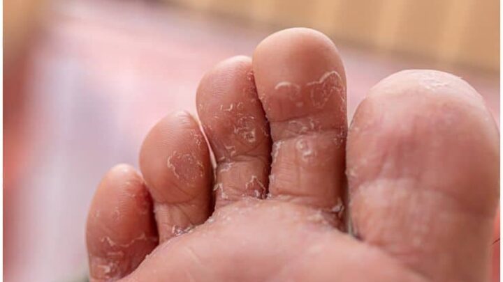 Athlete's Foot (Tinea Pedis) - Spiritual Meaning, Causes and Healing