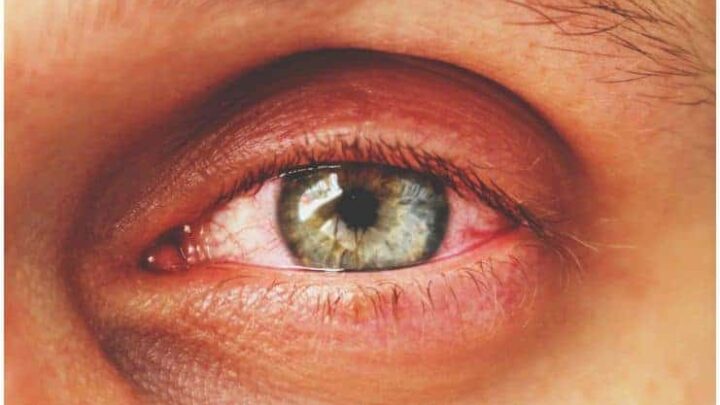 Conjunctivitis (Pinkeye) - Spiritual Meaning, Symptoms, Causes, Treatment, Prevention