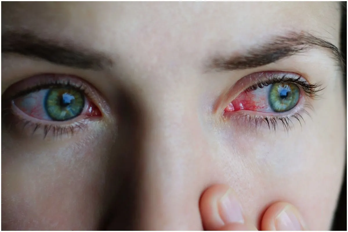 Spiritual Meaning Of Conjunctivitis