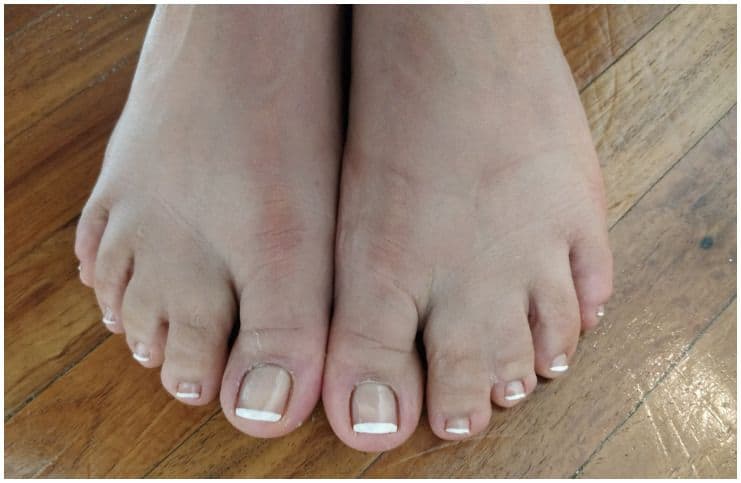 Spiritual Meaning Of Webbed Toes (Syndactyly)