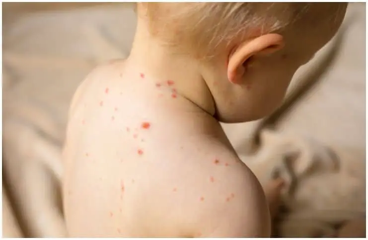 Spiritual Meaning of Childhood Illnesses (Measles, Chickenpox, Mumps, Scarlet Fever)