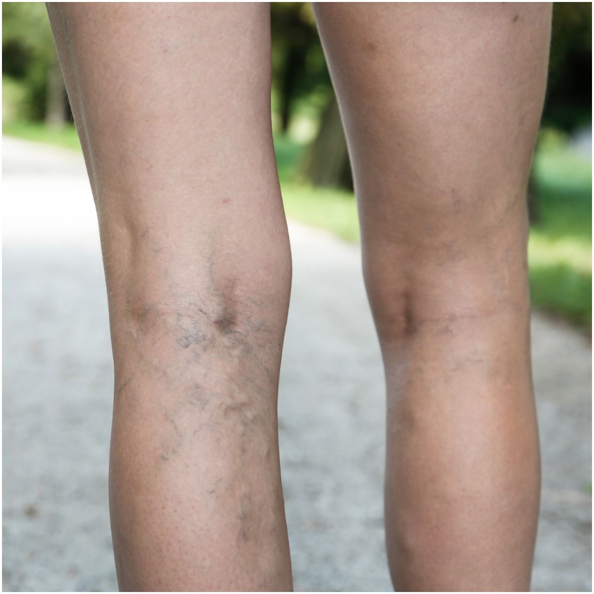 Spiritual Meaning of Varicose Veins