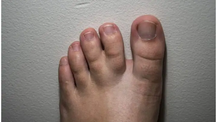 Syndactyly (Webbed Toes) - Spiritual Meaning & Causes