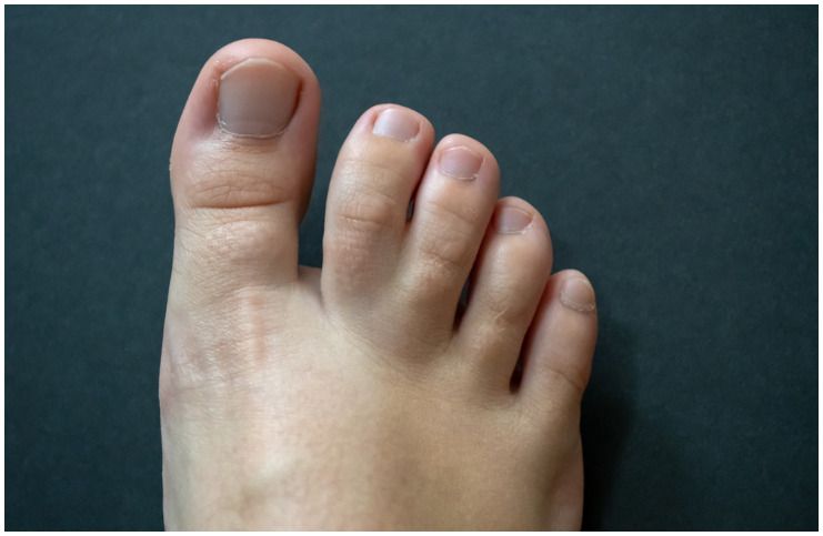 Webbed Toes (Syndactyly) causes