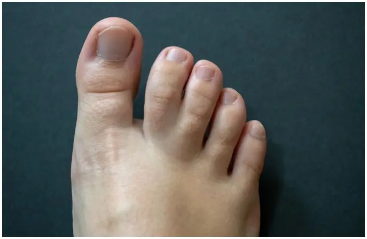 Webbed Toes (Syndactyly) causes