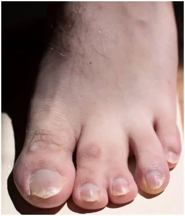 Webbed Toes (Syndactyly) on a foot
