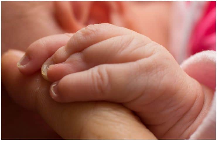 Webbed Toes (Syndactyly) on a hand