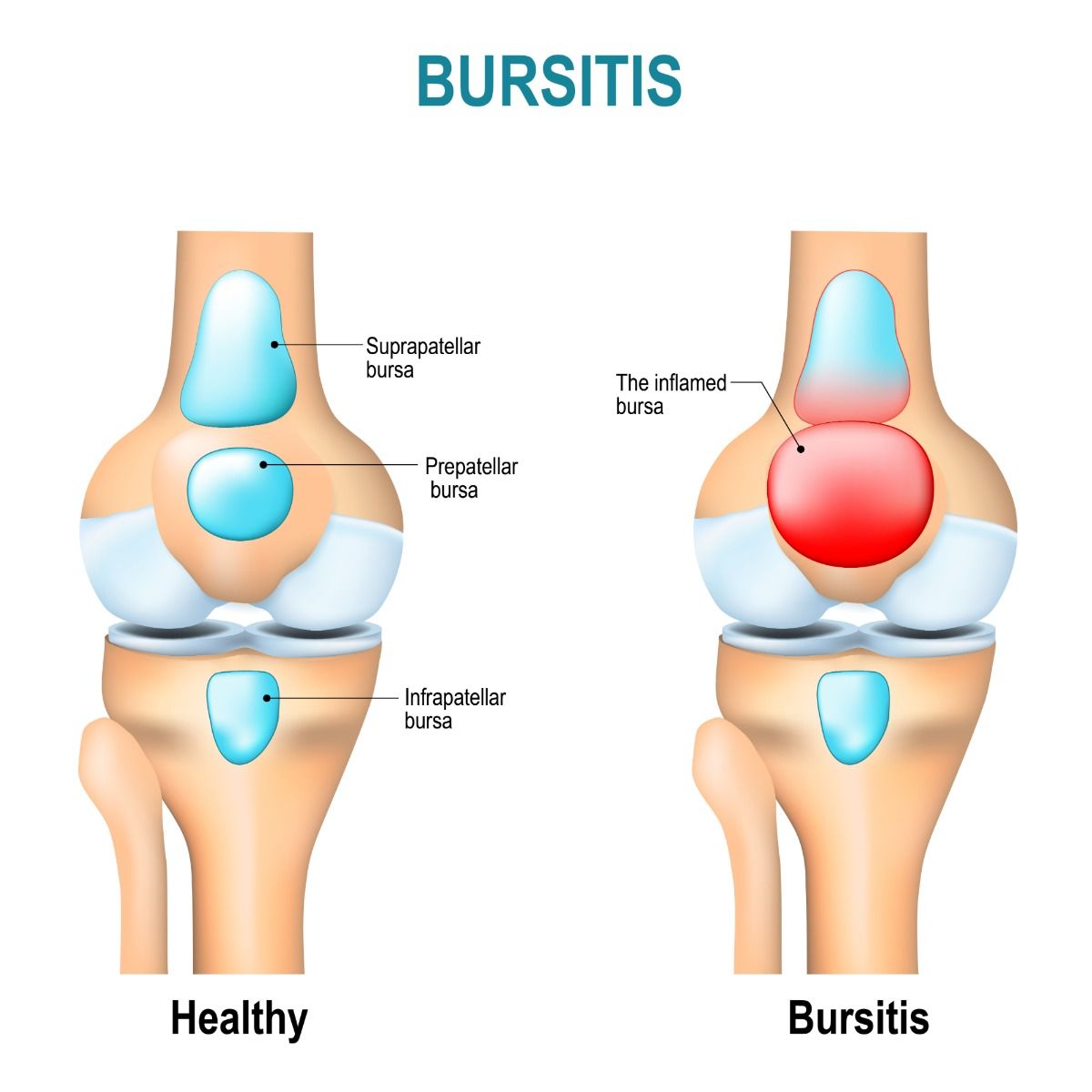 Bursitis Tendinitis – Spiritual Meaning & Causes