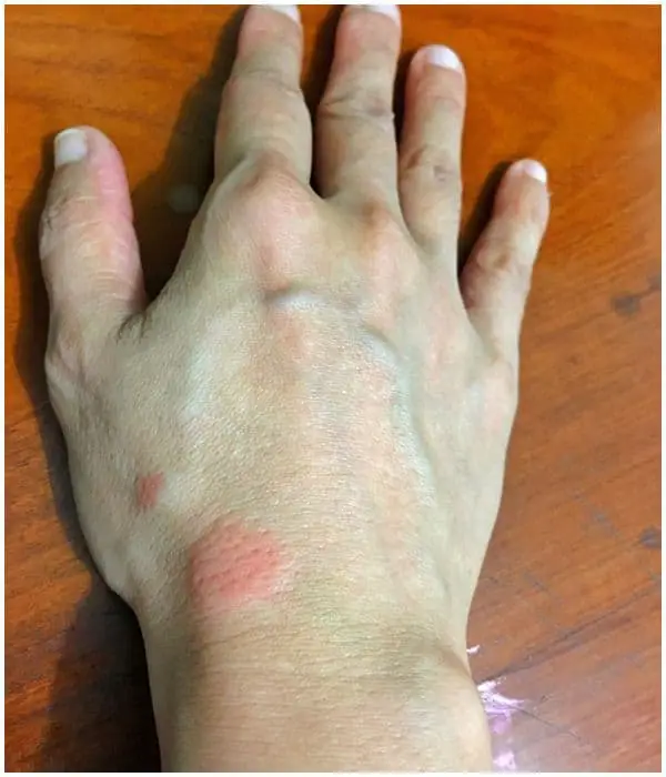 Systemic Lupus Erythematosus