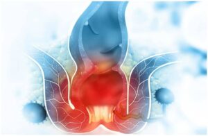 Hemorrhoids - Spiritual Meaning & Emotional Causes - Insight state