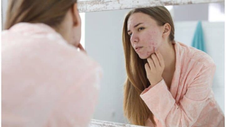 Acne, Psoriasis, Vitiligo & Skin Cancer - Spiritual Meaning and Emotional Causes