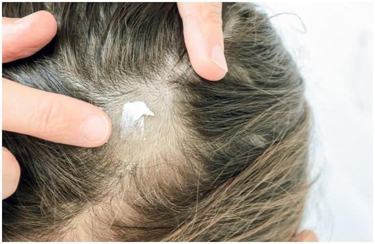 Scalp Infections