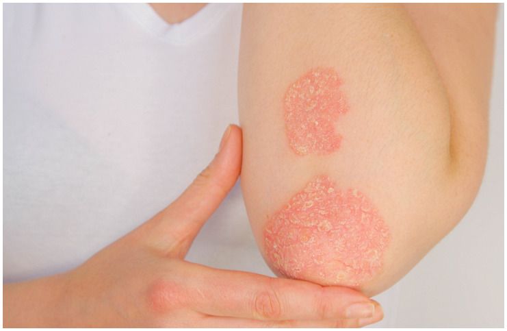 Spiritual Meaning and Emotional Causes of Psoriasis