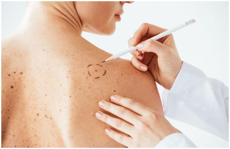 Spiritual Meaning and Emotional Causes of Skin Cancer (Melanoma)