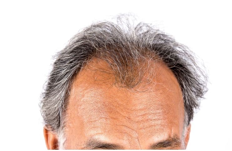 androgenetic alopecia