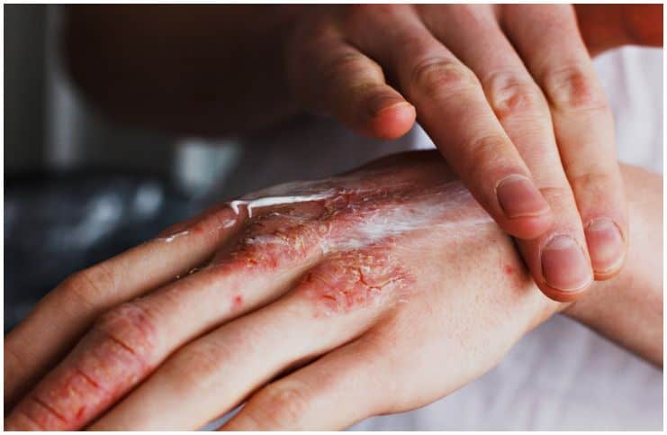 applying the ointment on the hands with eczema