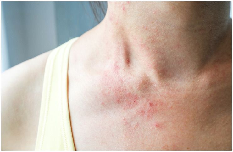  skin rash itch on neck