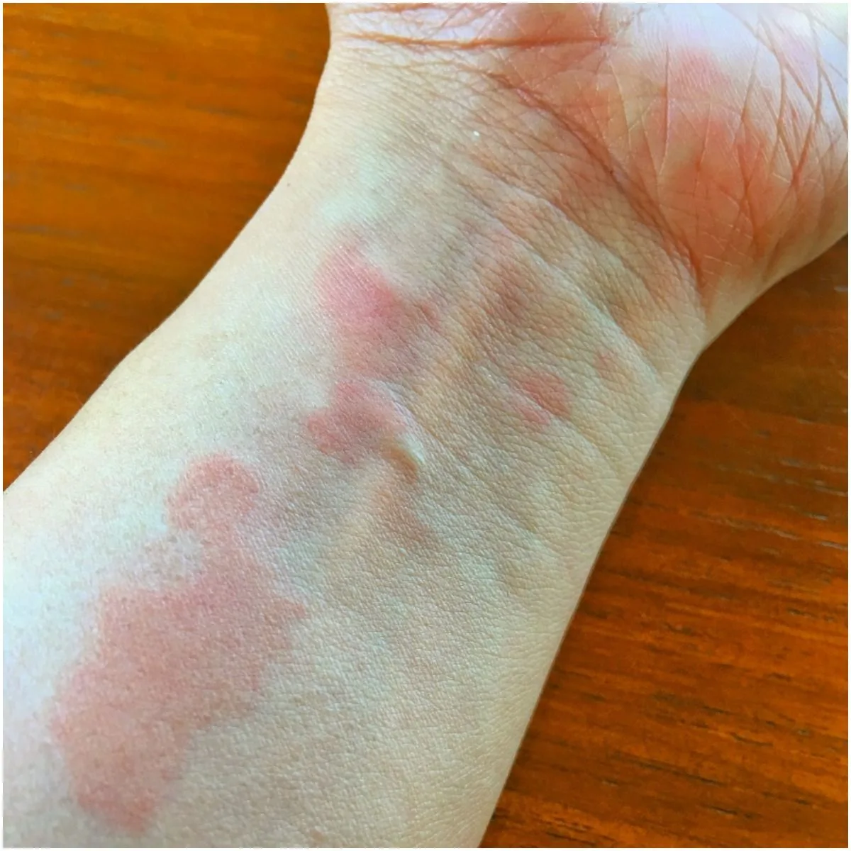 Systemic Lupus Erythematosus(