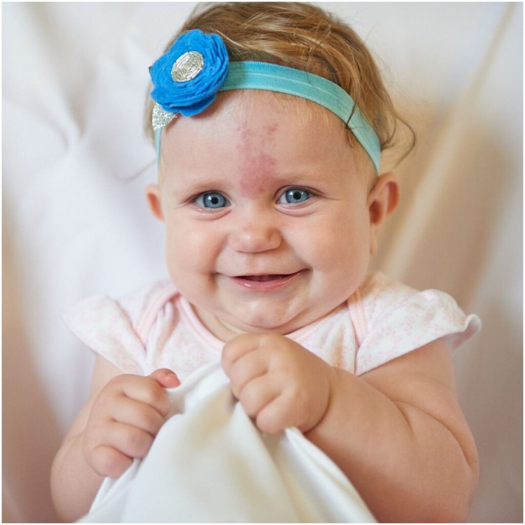 Birthmarks Spiritual Meanings & Superstitions Insight state