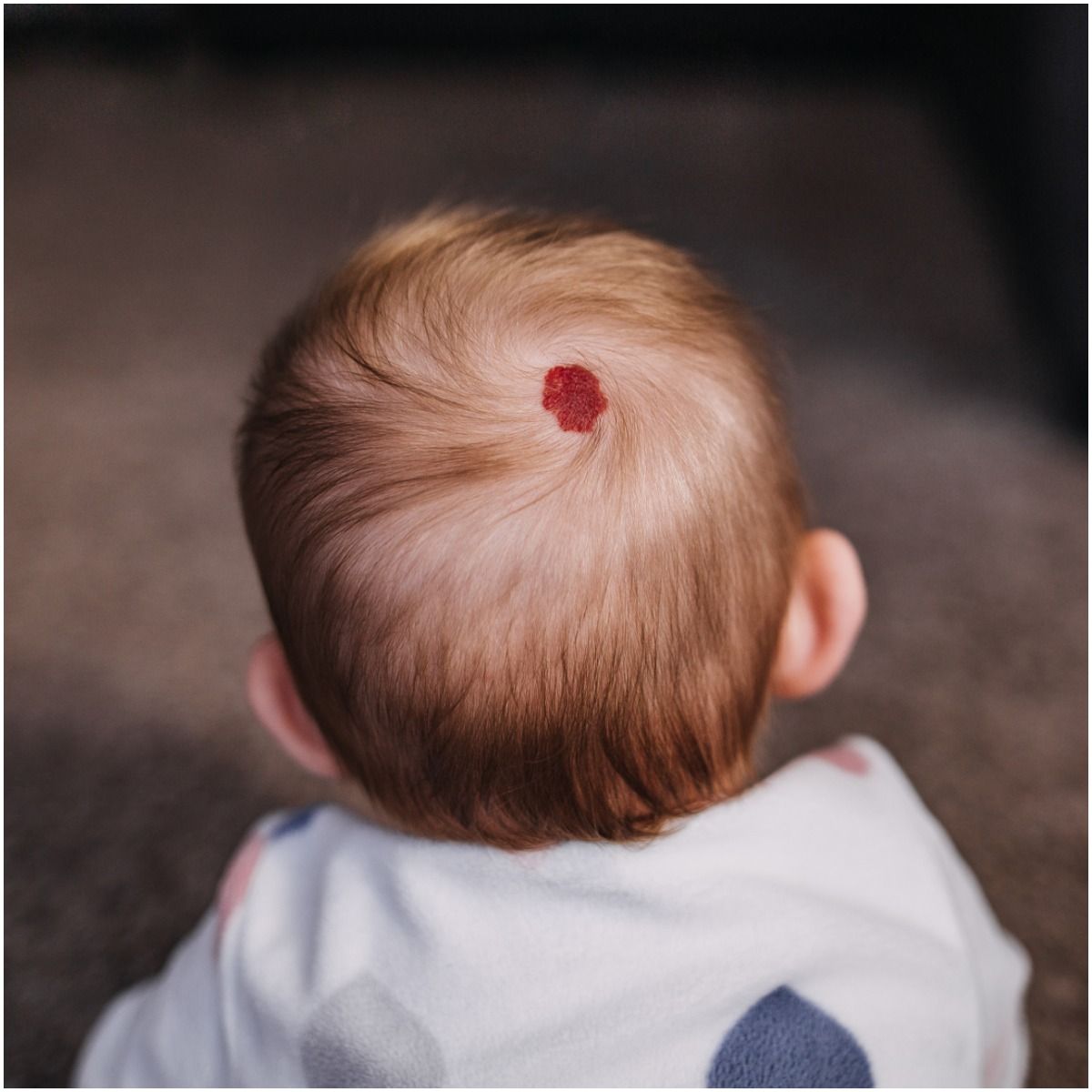 birthmark on baby head