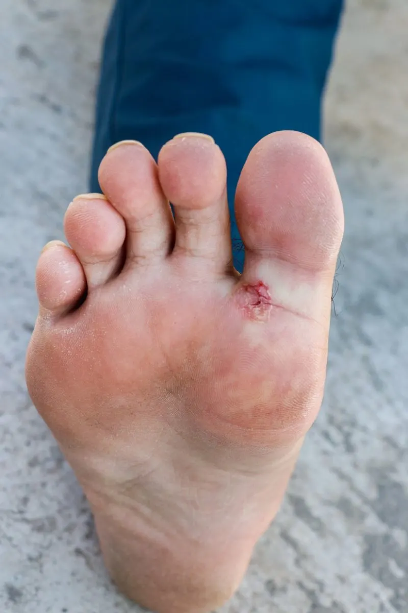 Athlete's Foot (Tinea Pedis) Spiritual Meaning, Causes and Healing